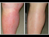 ADVANCED PSORIASIS & ECZEMA CREAM