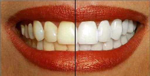 Perfect Teeth Whitening Pen