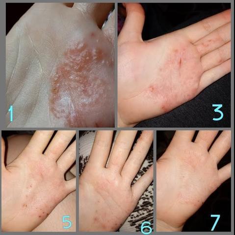 ADVANCED PSORIASIS & ECZEMA CREAM