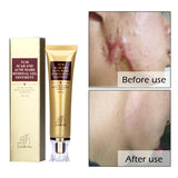 ACNE SCAR REMOVAL CREAM