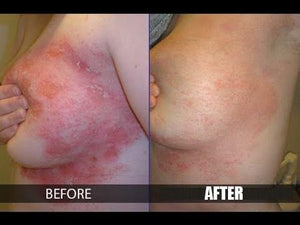 ADVANCED PSORIASIS & ECZEMA CREAM